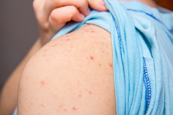 varicella with red spots on the shoulder
